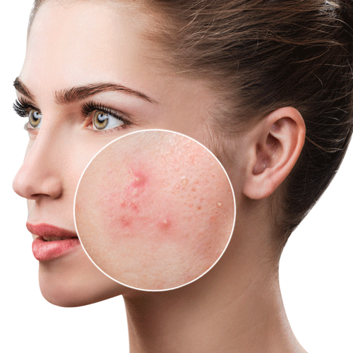 acne and pimples on face