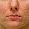 woman with severe acne scars