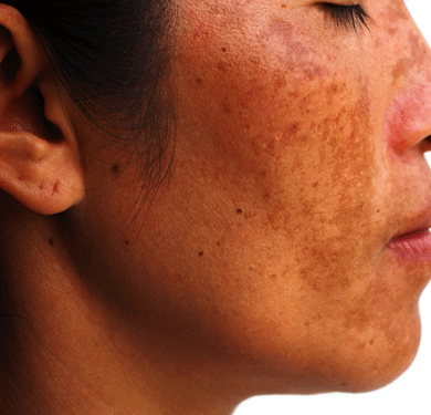 face with melasma