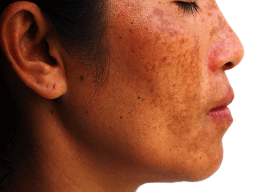 face with melasma
