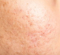 mixed type acne scar