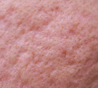 rolling acne scar