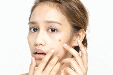 acne skin breakout