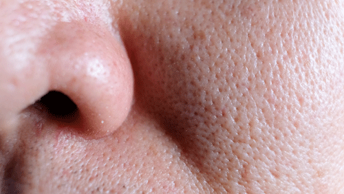 large pores on face