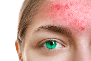 red inflamed skin