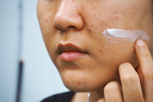 acne cream breakout